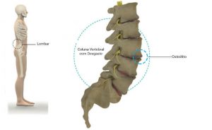 Osteofitose